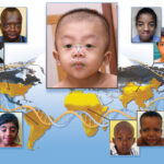 famous people with noonan syndrome