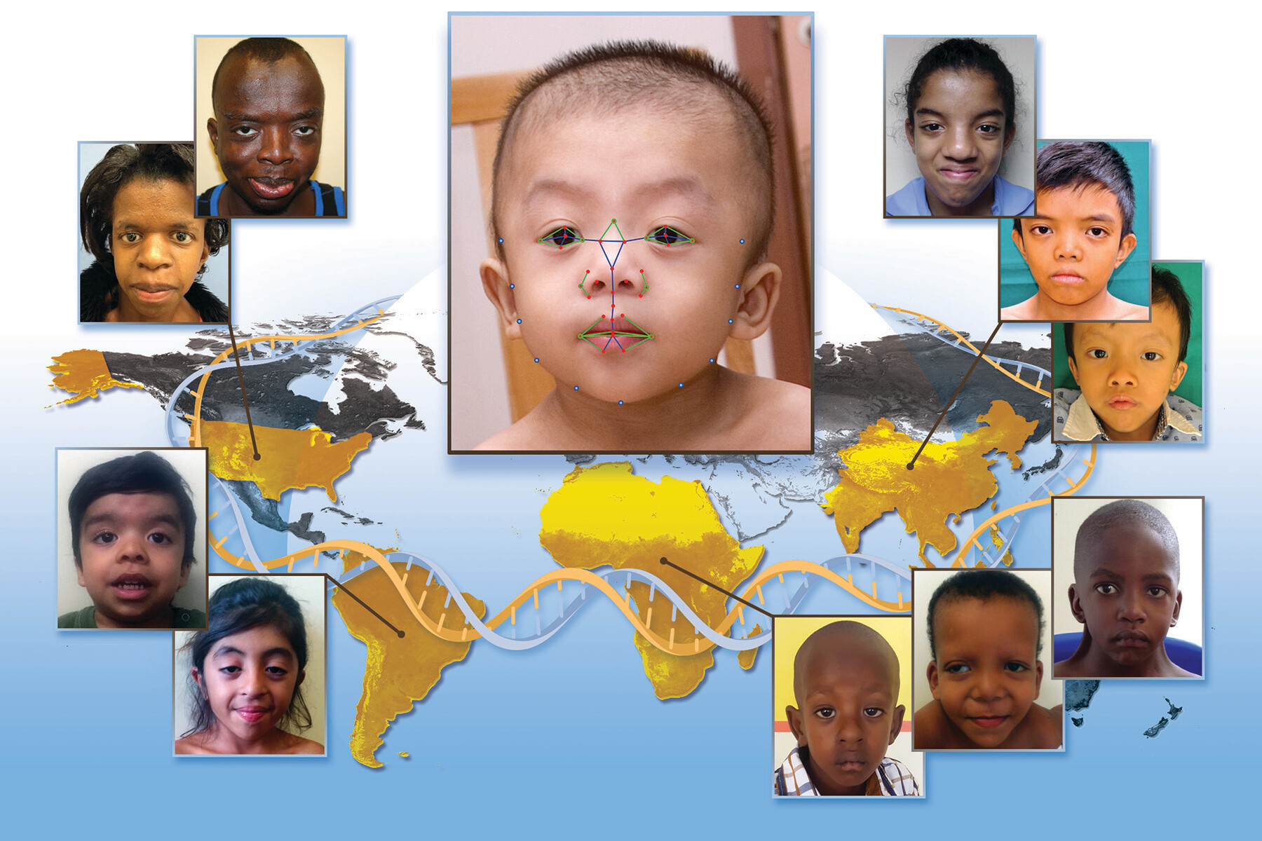 famous people with noonan syndrome